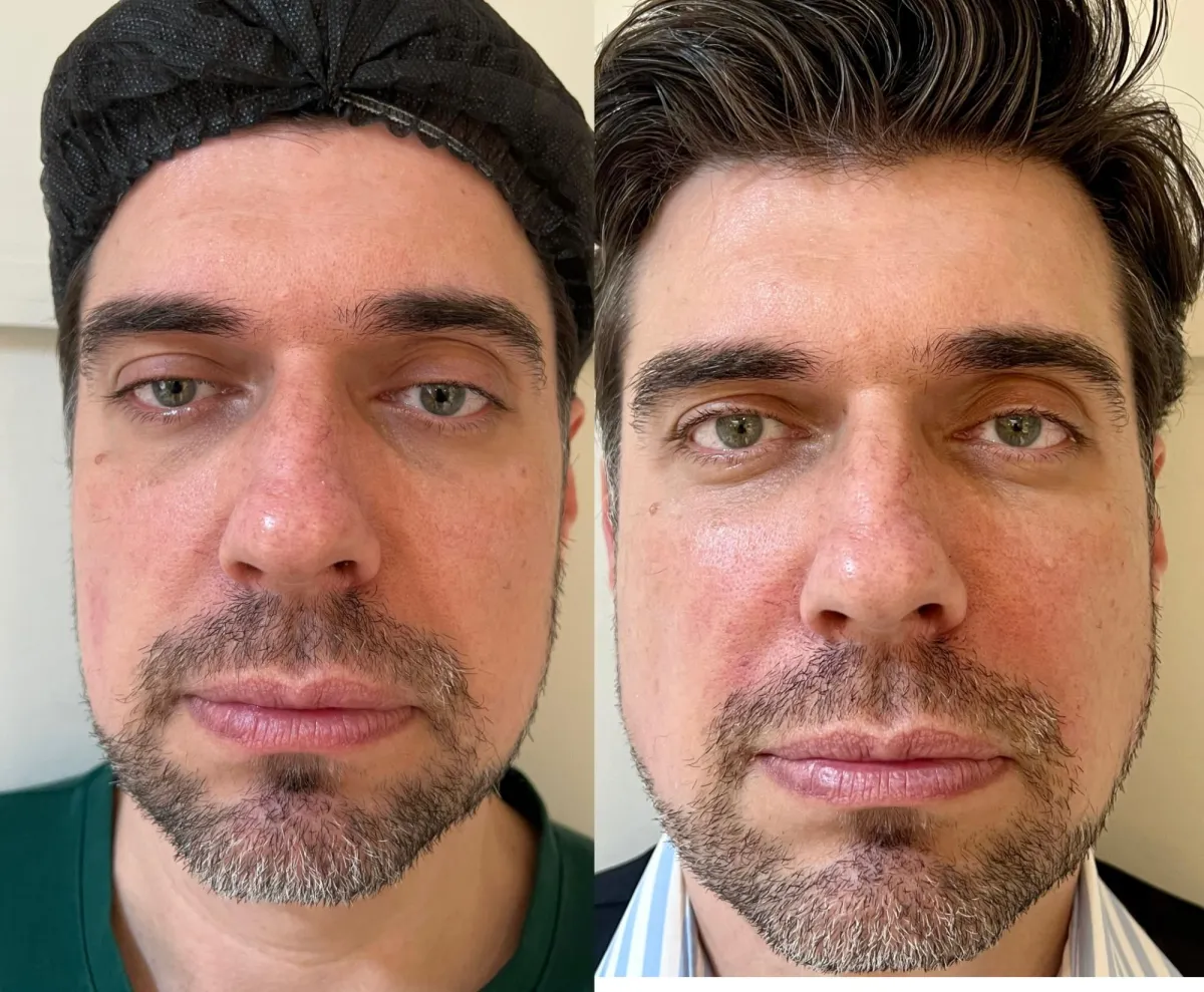 Antes e depois de paciente homem tratado com Sculptra e Ultraformer: rosto de frente