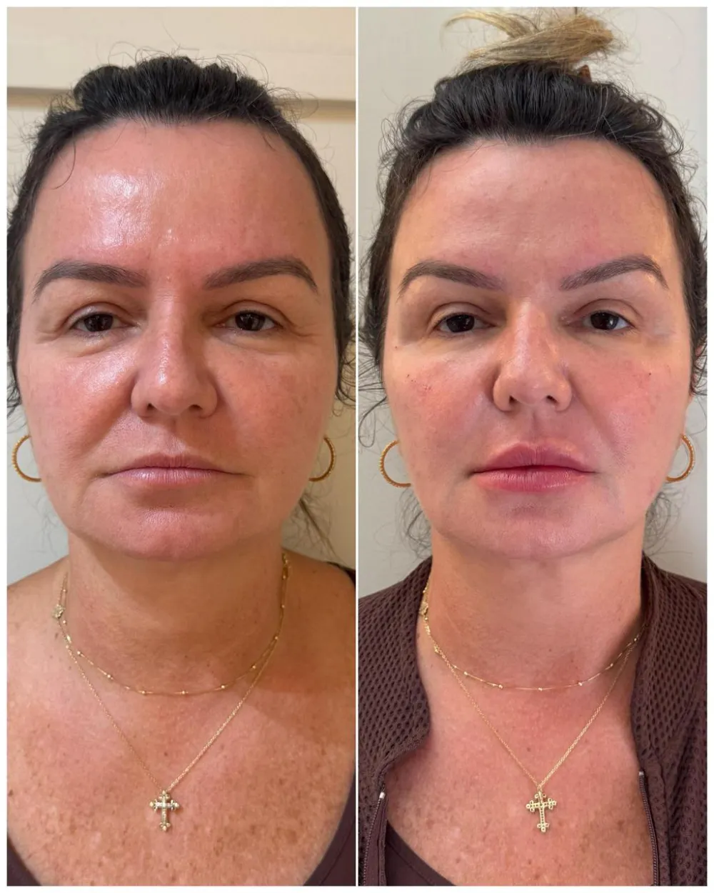 Antes e depois de preenchimento facial em paciente mulher, de frente