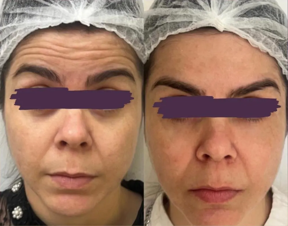 Exemplo de antes e depois de toxina botulínica, com tarja nos olhos