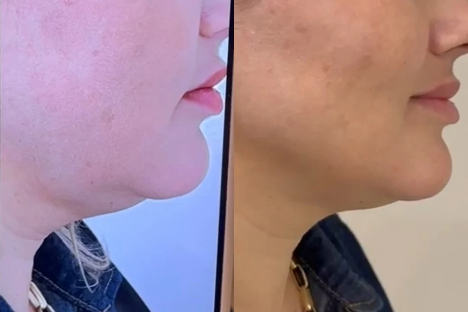 Exemplo de antes e depois de Ultraformer na papada