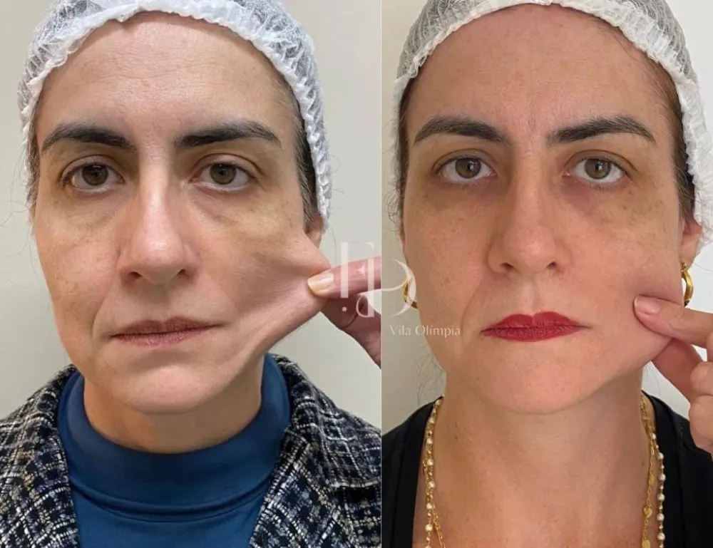 Antes e depois de Sculptra no rosto