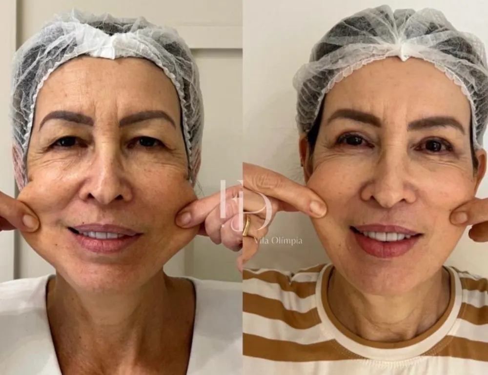Antes e depois de Sculptra no rosto