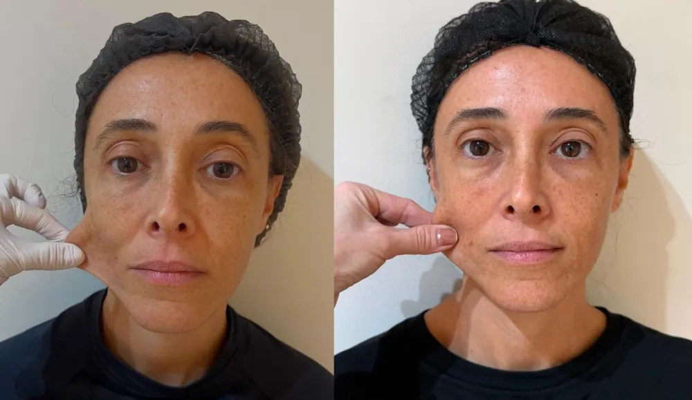 Antes e depois de Sculptra no rosto