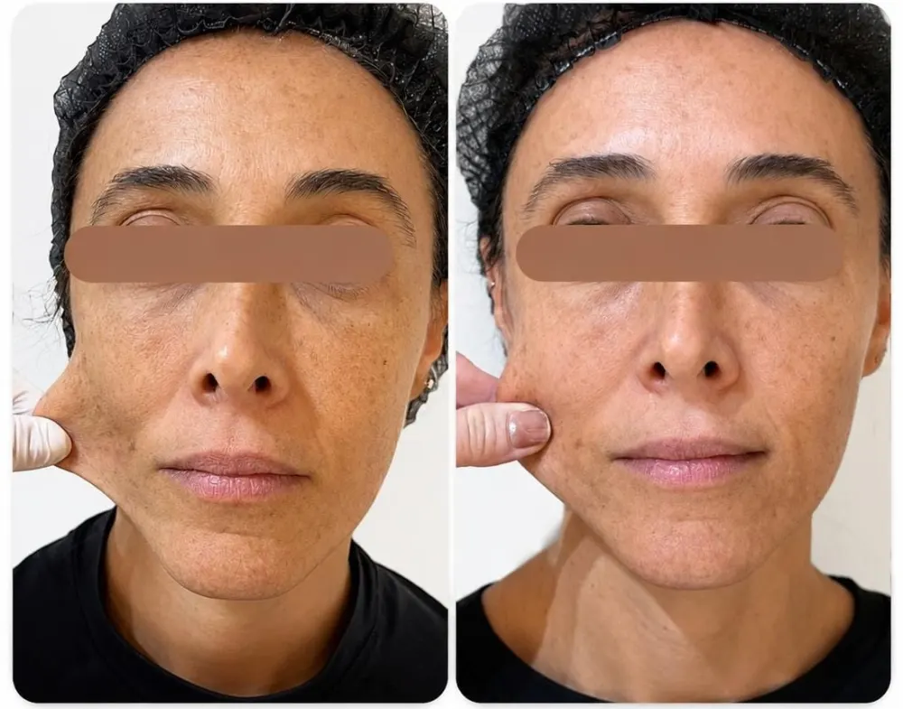 Exemplo de antes e depois de Sculptra, com tarja nos olhos