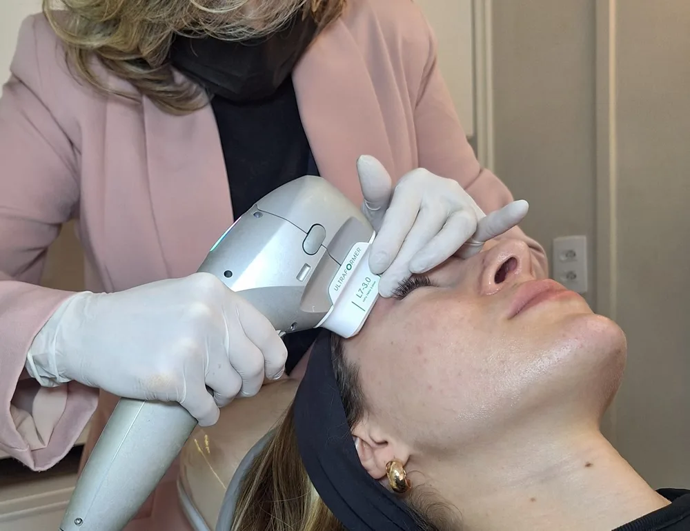 Aplicação de Ultraformer no rosto na Face Doctor