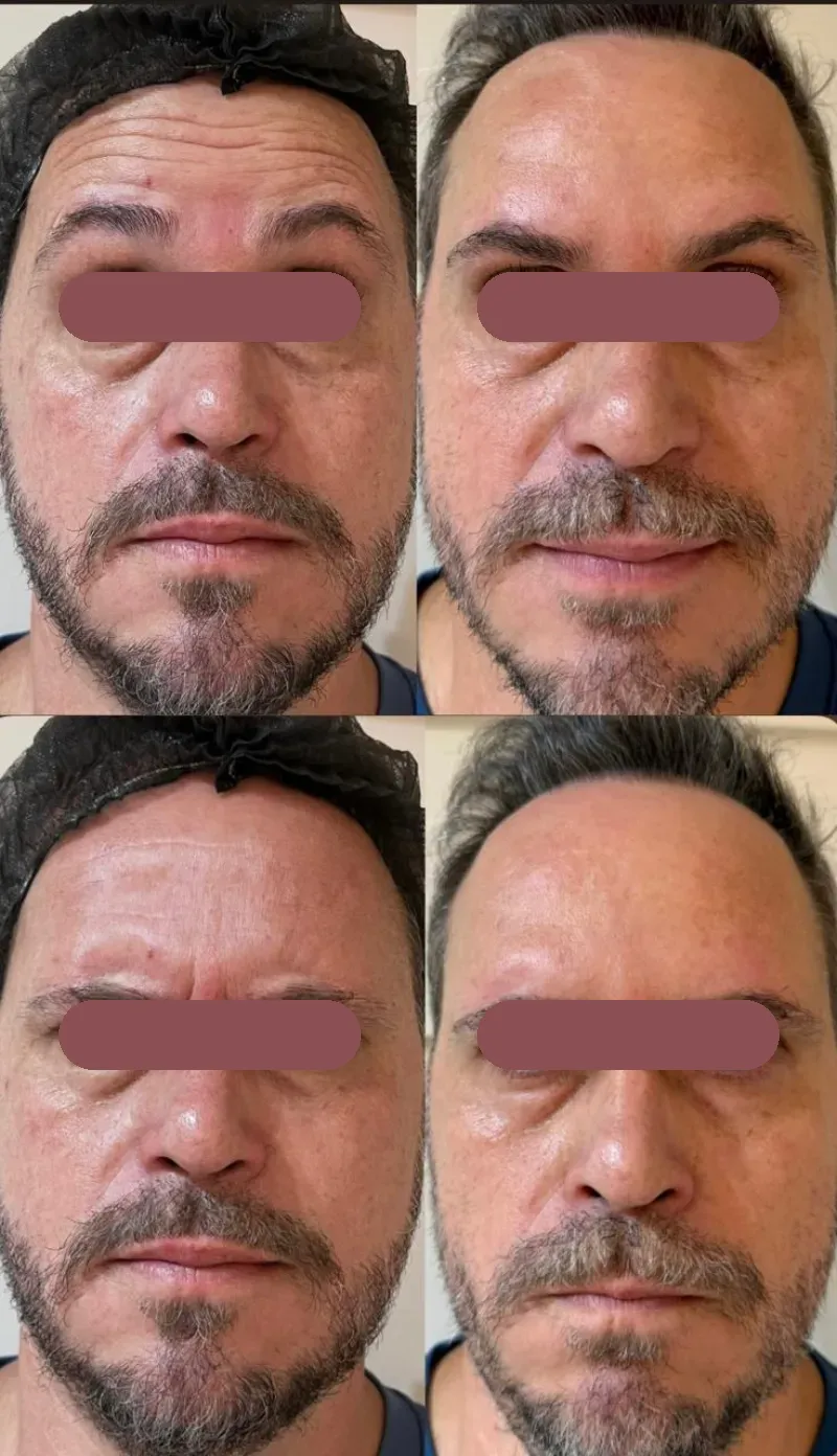 Antes e depois de toxina botulínica em paciente homem, com tarja nos olhos: testa e região entre as sobrancelhas, em expressão
