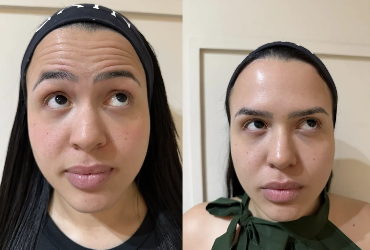 Antes e depois de toxina botulínica na testa: à esquerda, linhas ao levantar as sobrancelhas; à direita, testa lisa